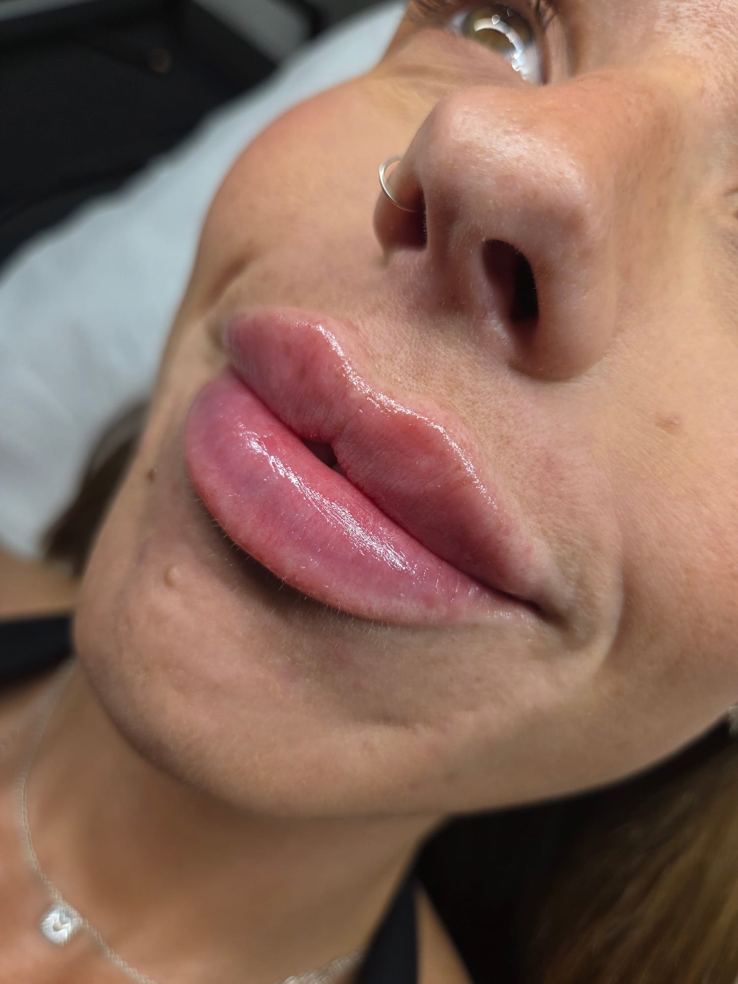 Lip filler result, side profile