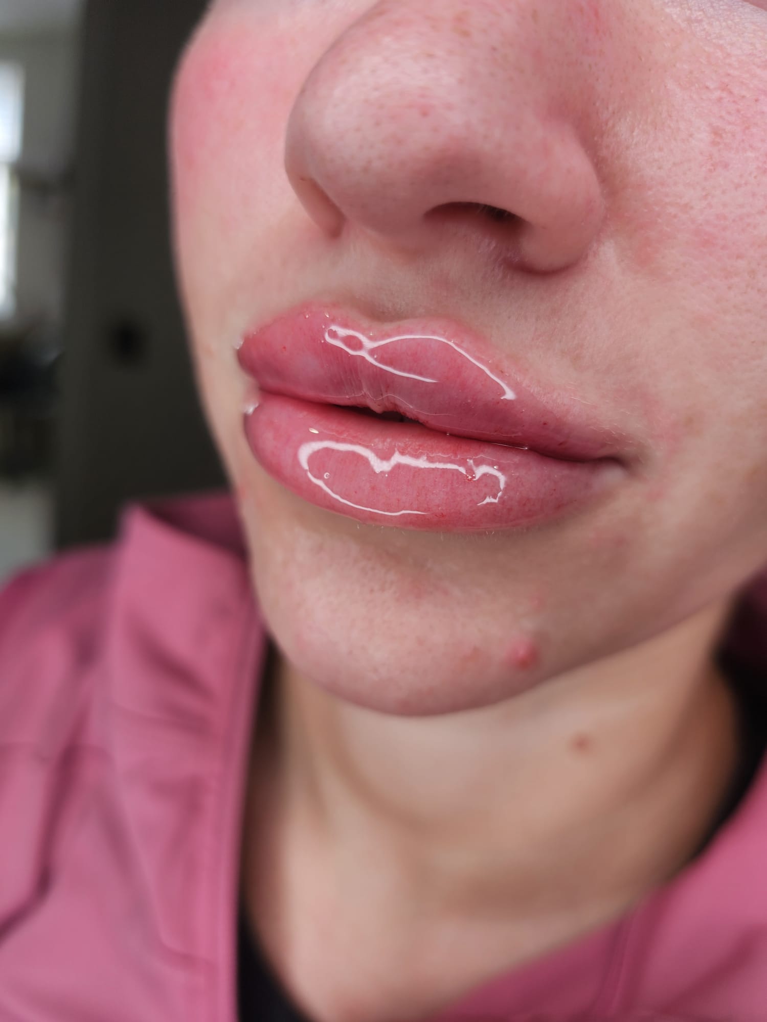Lip enhancement result front on
