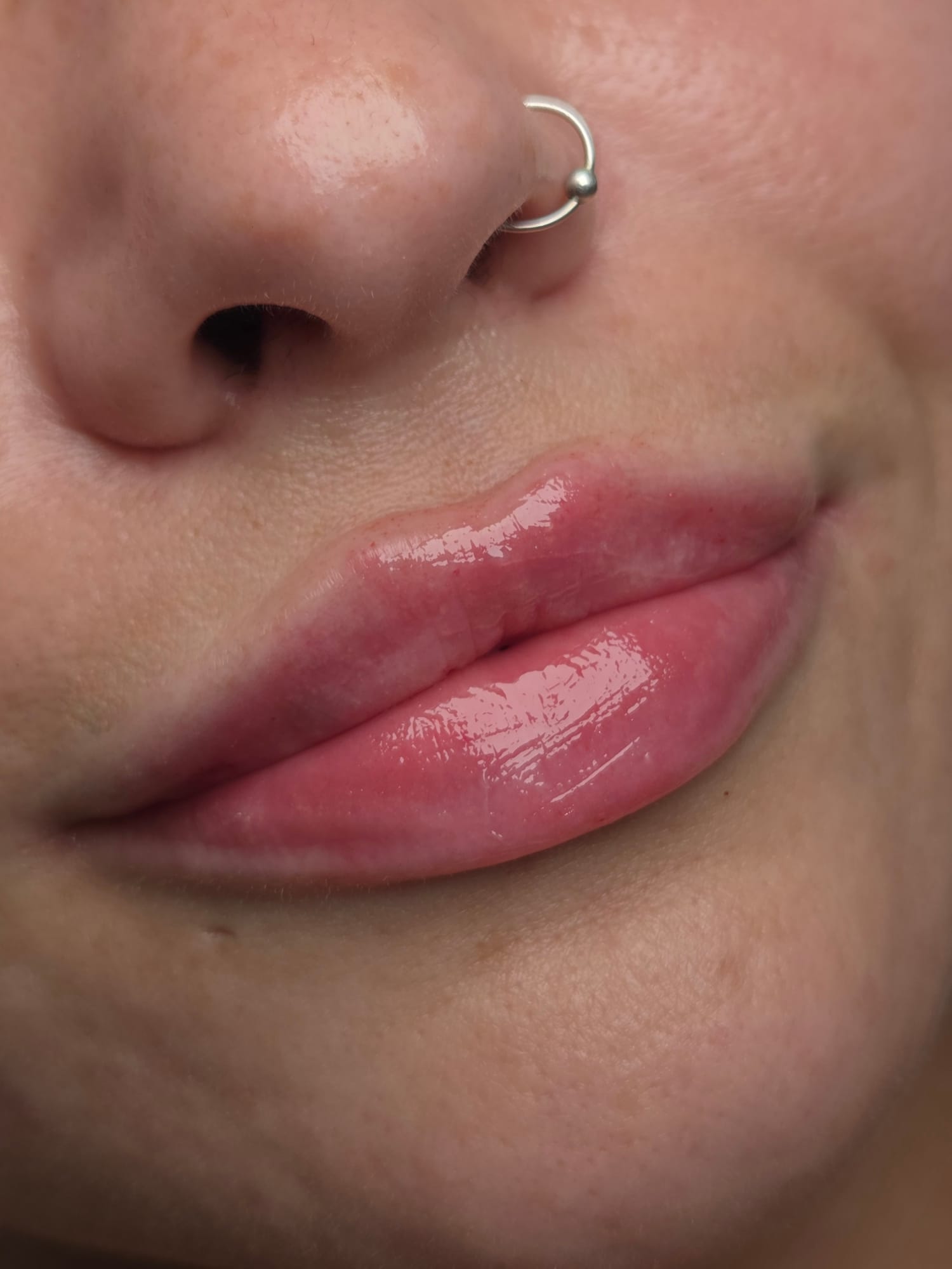 Lip Enhancement