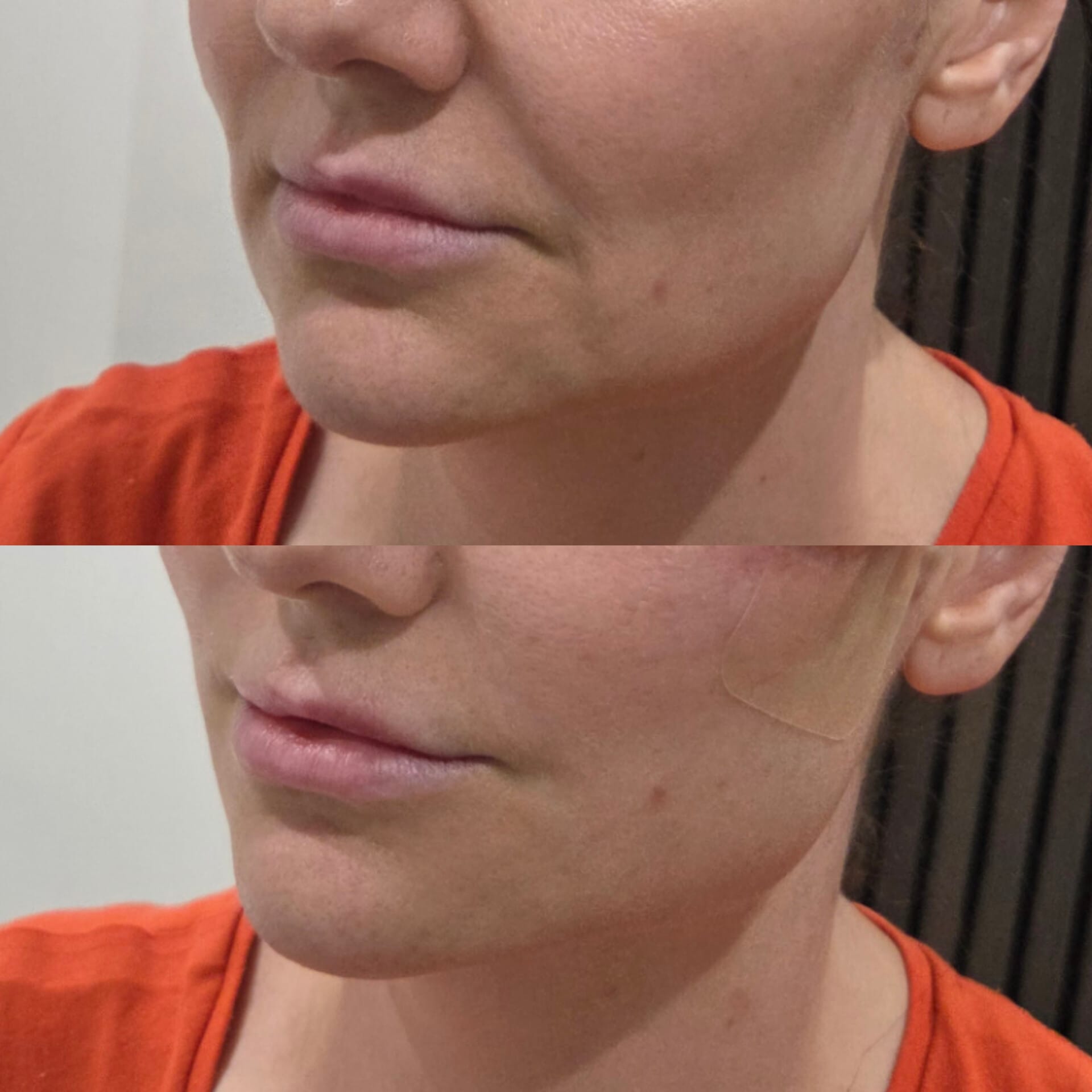 Jawline profile before and after comparison