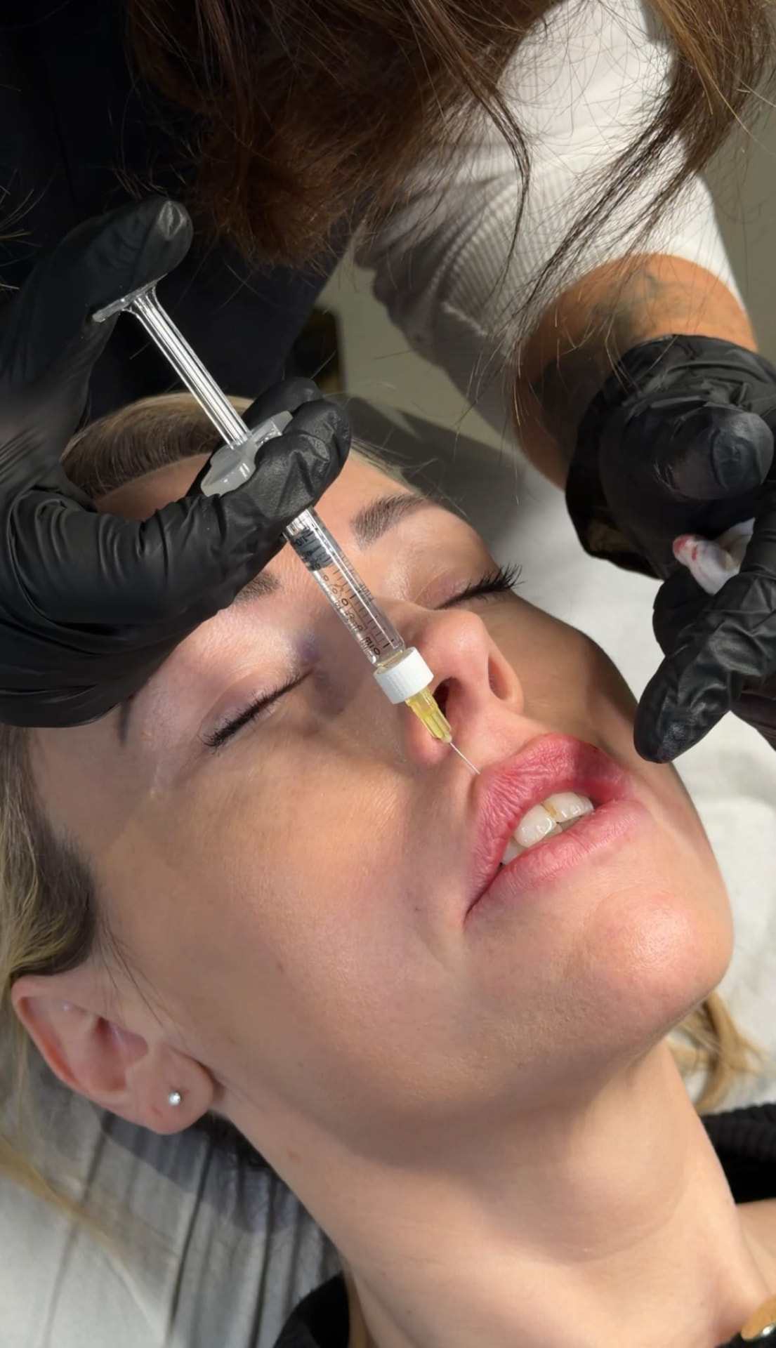 Lip filler being injected during an appointment