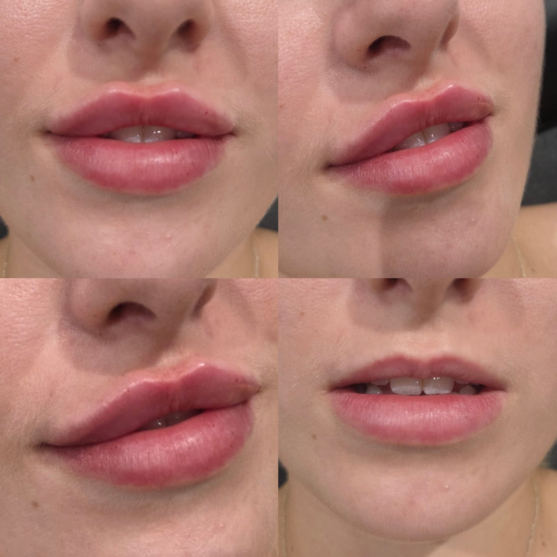 Lip filler results shown from four angles