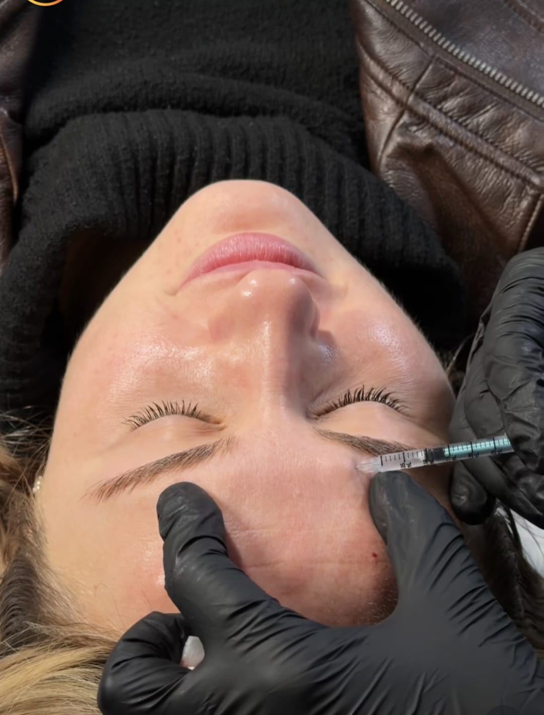 Anti-wrinkle injection around the eye area
