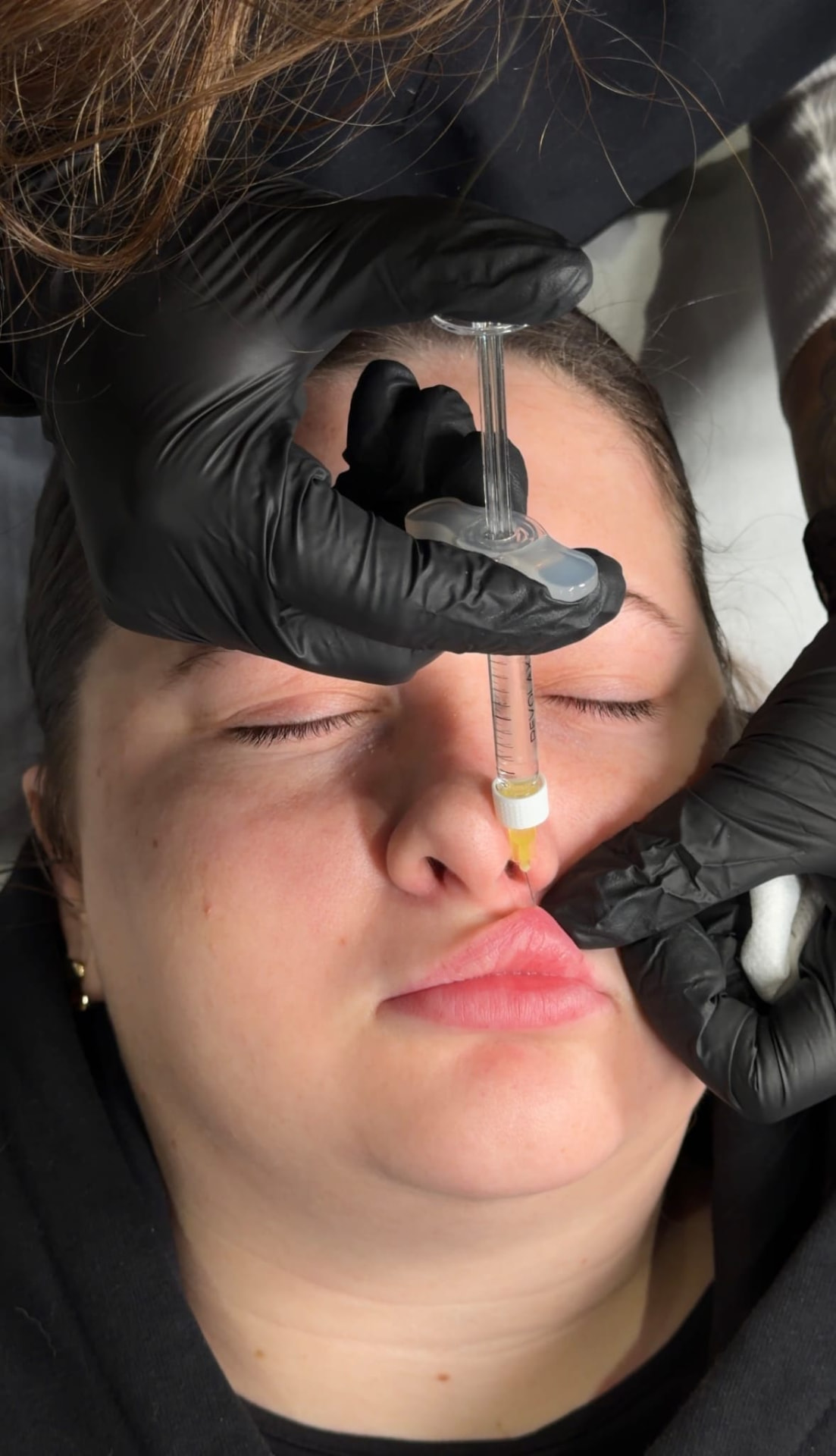 Dermal filler treatment in progress