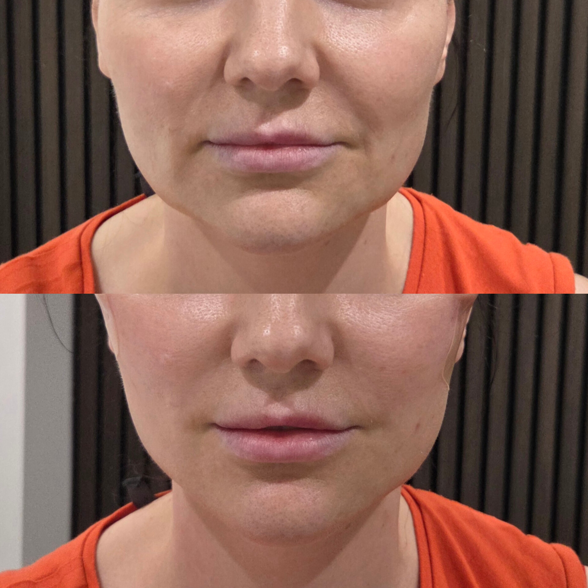 Lower face before and after comparison
