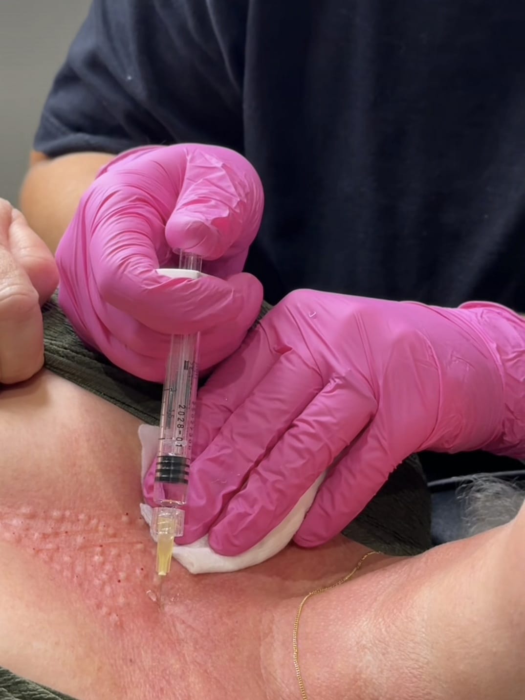 Skin booster injection in progress